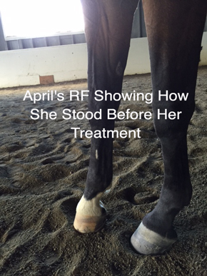 April's RF Showing How She Stood Before Her Treatment